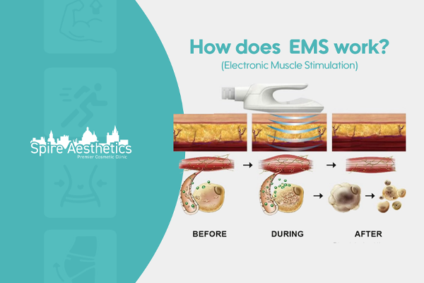 EMS treatment for post pregnancy weight loss treatment Berkshire