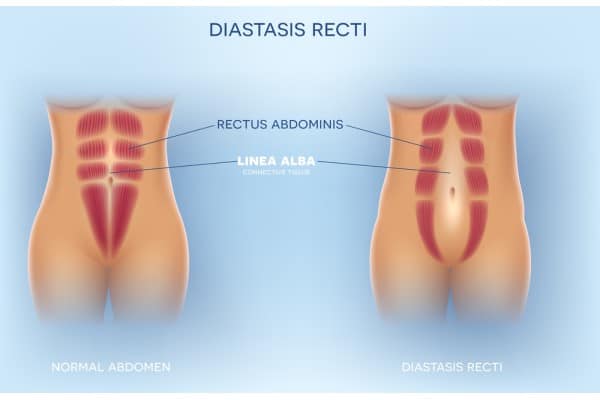 What Non-Surgical Options Are Available for Diastasis Recti Berkshire?