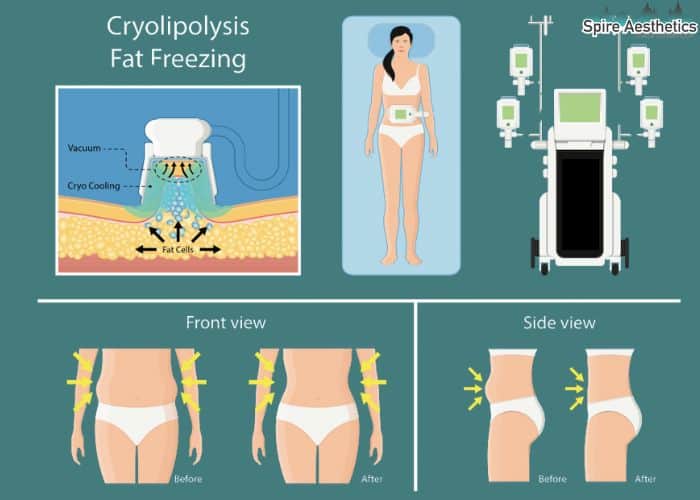 Image of diet and fat freezing combined for best results for Spire Aesthetics Berkshire