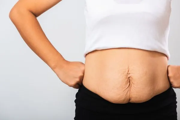Image of a woman's stomach after weight loss with sagging skin following a gastric band Berkshire