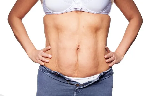 sagging skin on woman's stomach after weight loss injections Berkshire