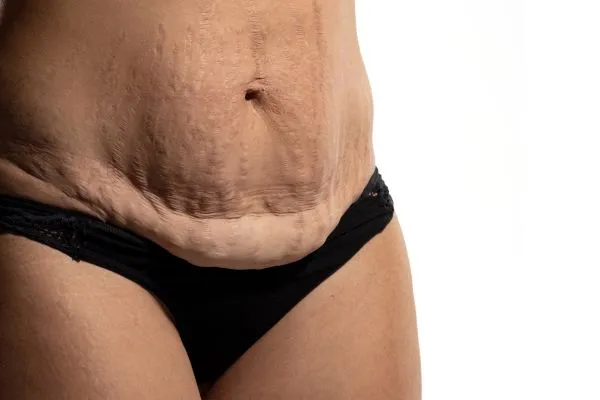 Image of womans stomach after weight loss injections Berkshire showing saggy skin