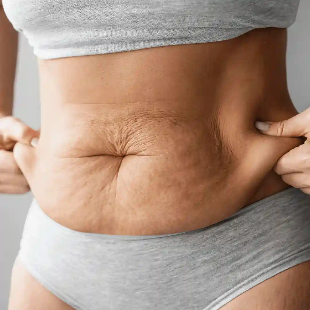 Is It Normal to Have Loose Skin After Pregnancy Berkshire?