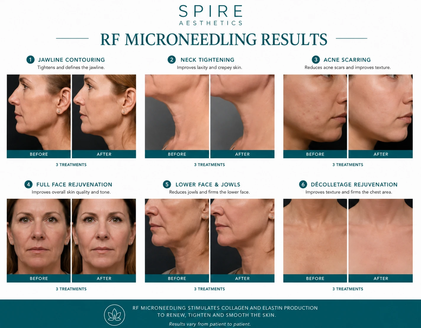 RF Microneedling Skin tightening Berkshire results