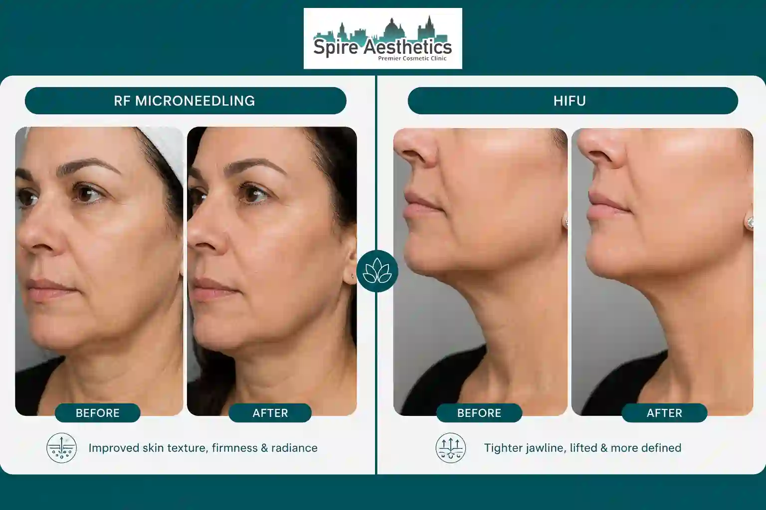 Can RF Microneedling and HIFU Be Combined Berkshire?
