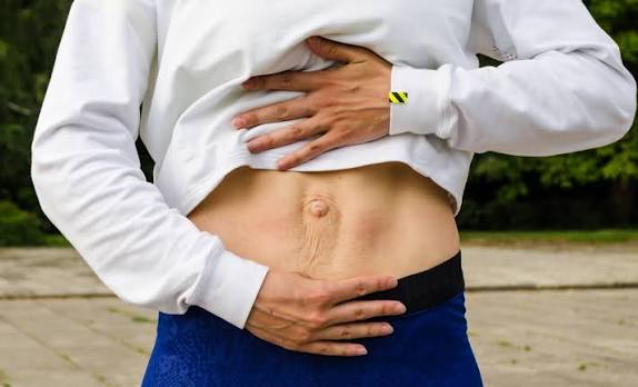 When Could Diastasis Recti Be the Missing Piece of the Puzzle Berkshire?