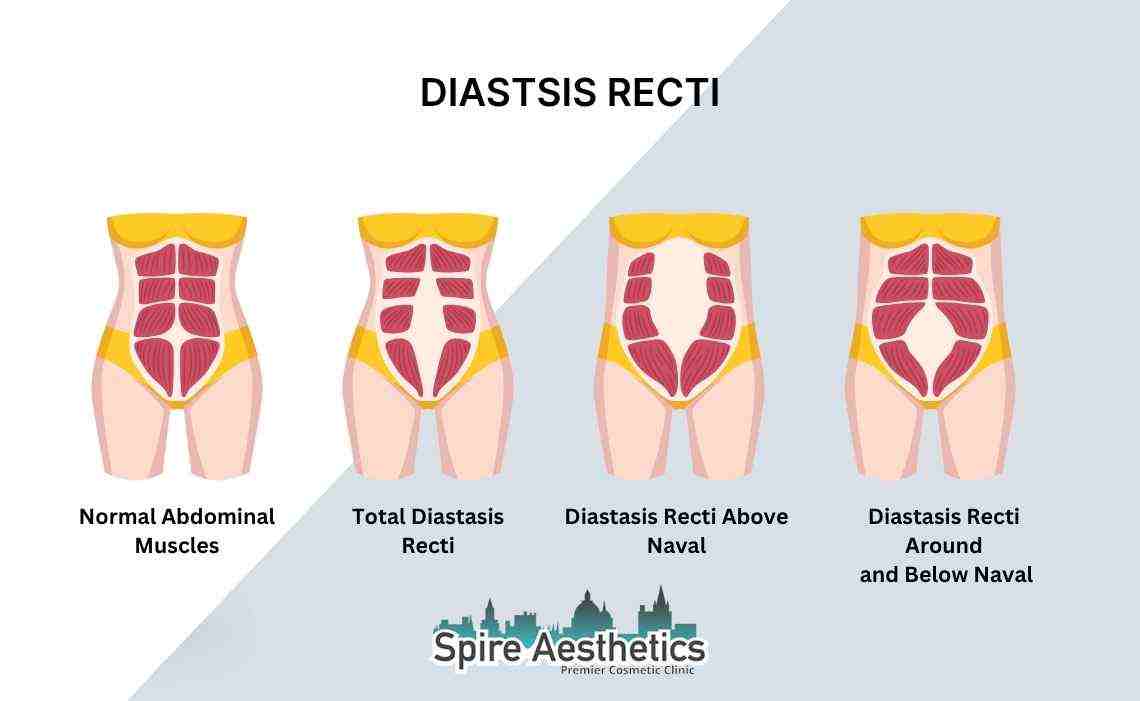 Is Non-Surgical Diastasis Recti Treatment Right for You? Common Concerns Answered Berkshire